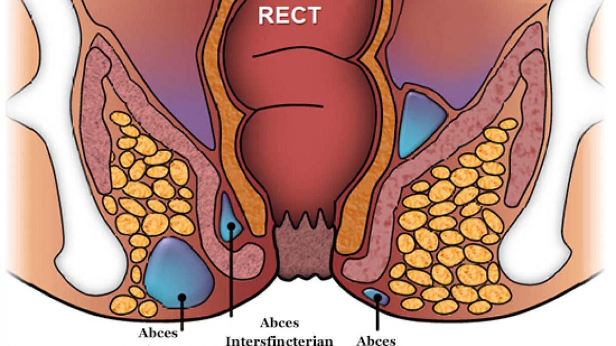 infectiile urinare la barbati simptome tratamentul prostatitei incipiente